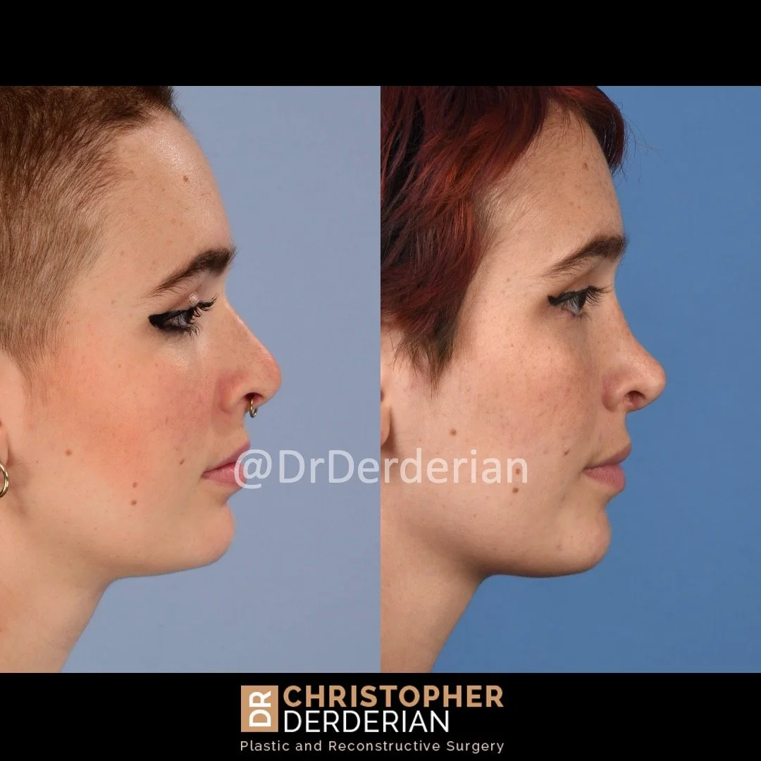 DrDerderian Rhinoplasty Before and After 10.1.2022 right.jpeg