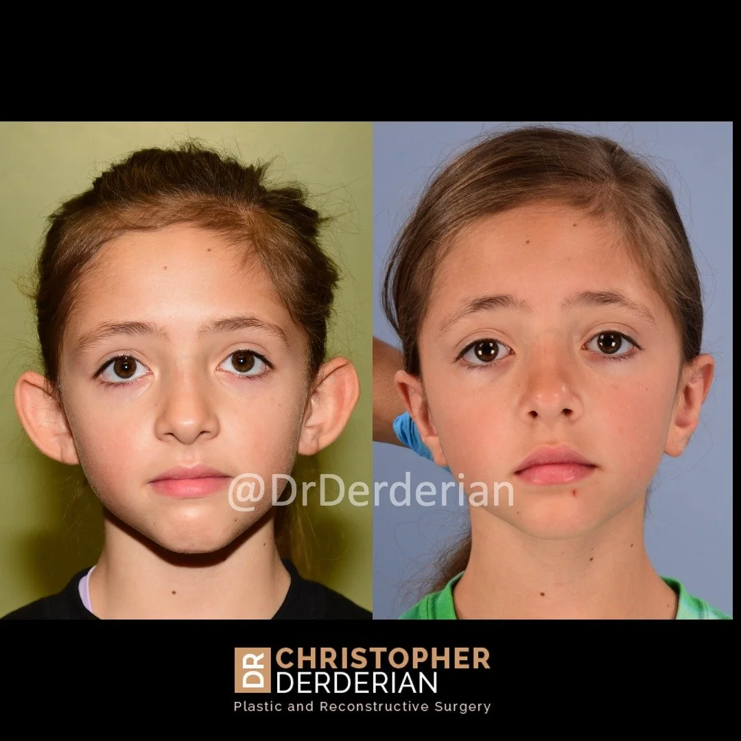before and after otoplasty case 10 AP