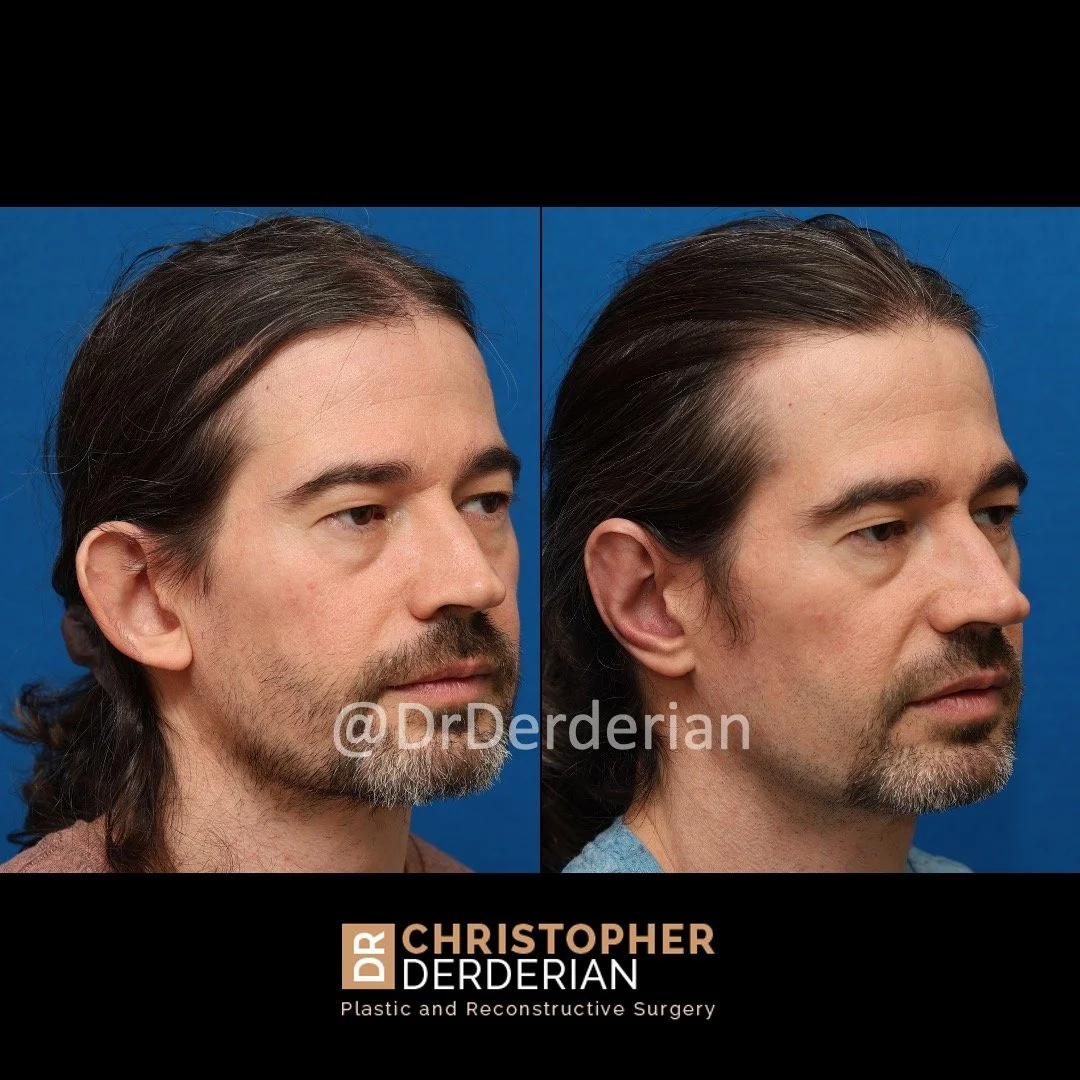 Otoplasty before and after right 3/4