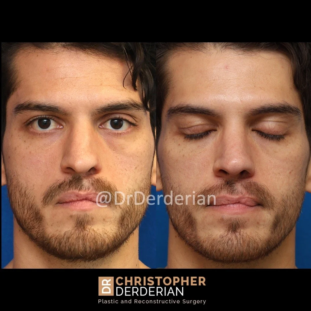 Before and after cleft rhinoplasty front view