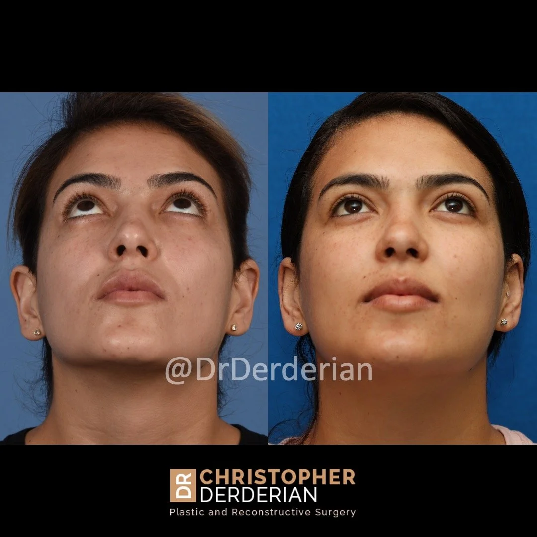 before and after ear reduction procedure, reduction otoplasty below view