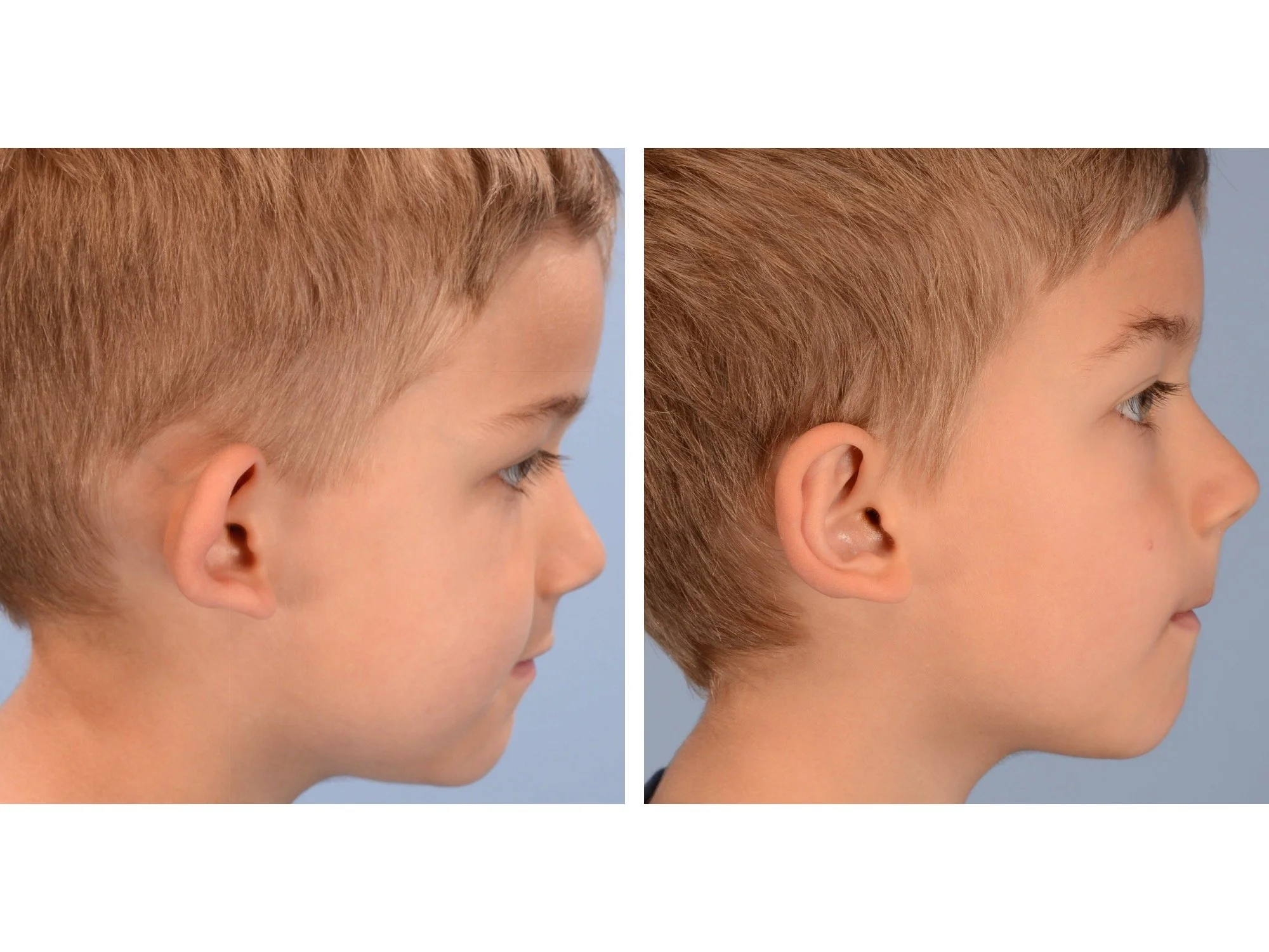 otoplasty before and after case 1 Right Lateral