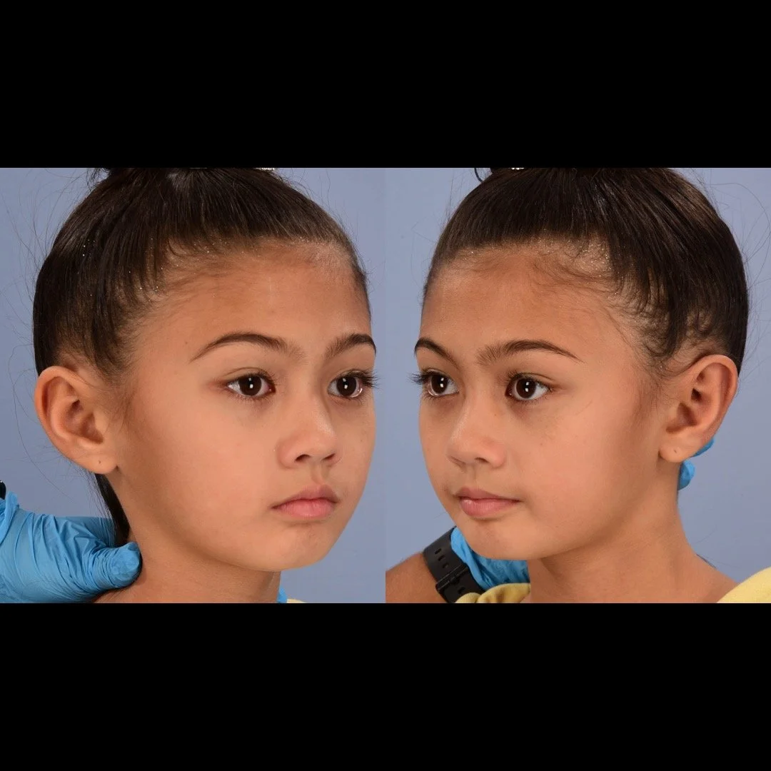 otoplasty before and after case 3 3/4 mirror