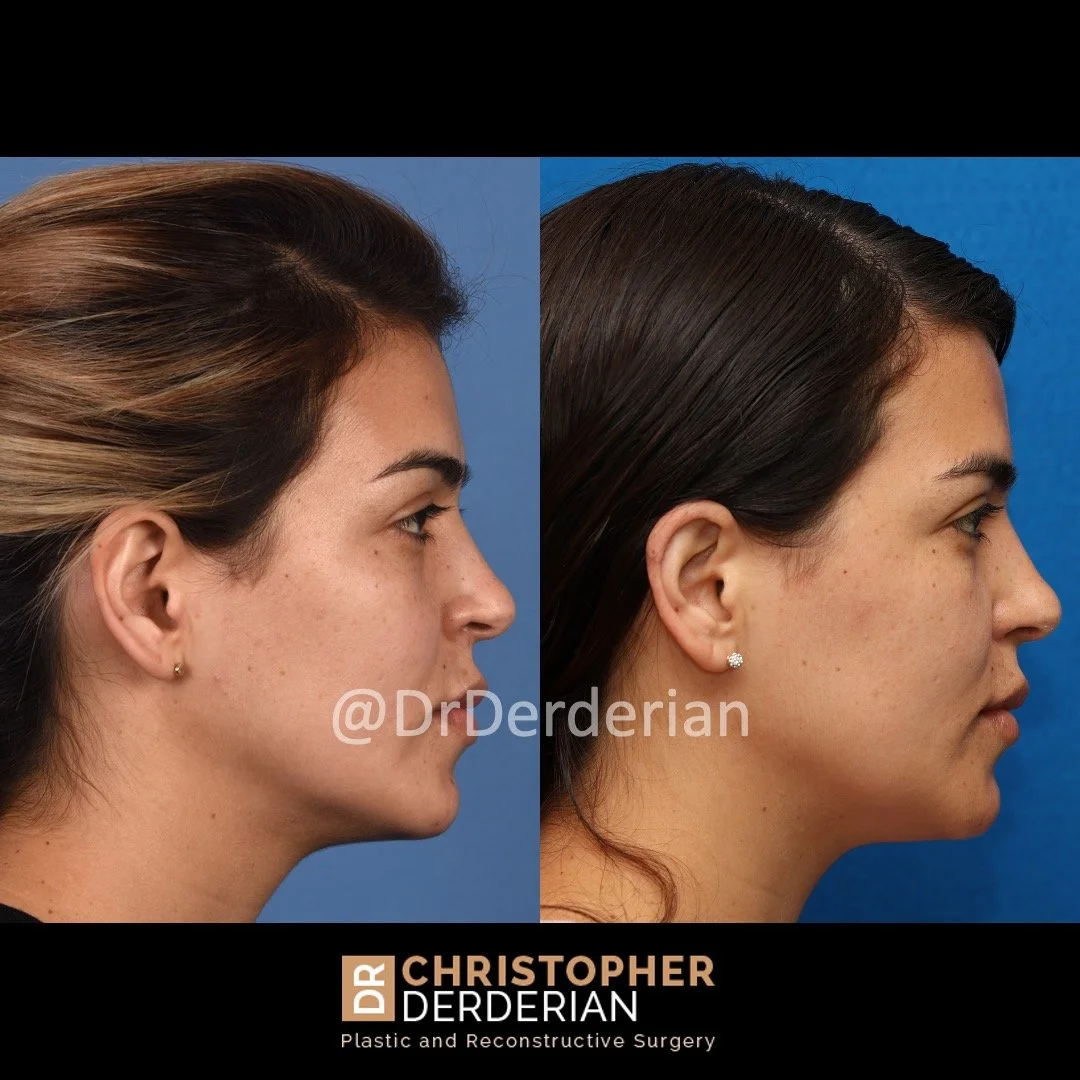 before and after ear reduction procedure, reduction otoplasty