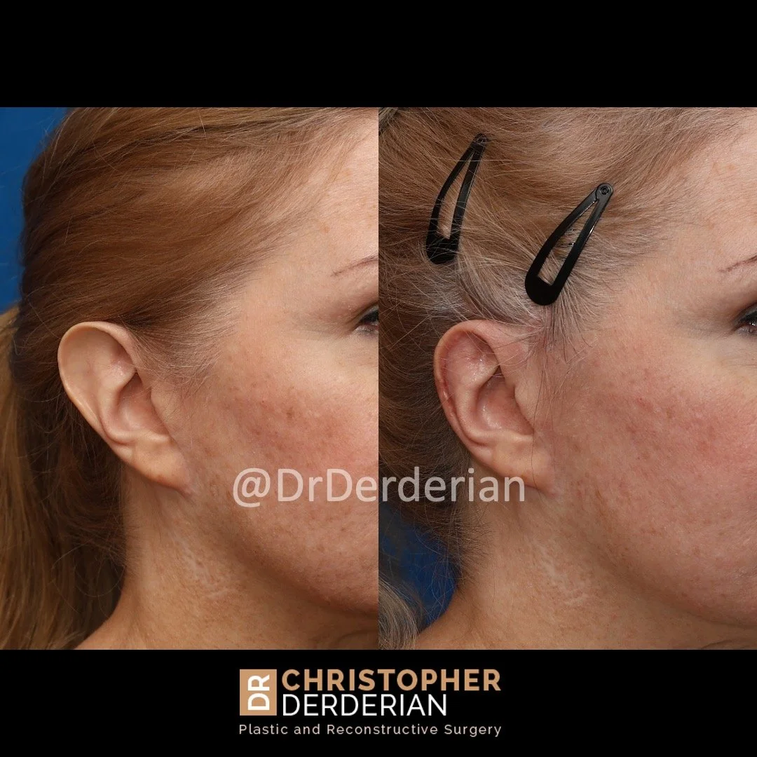 Before and after ear reduction surgery right 3/4