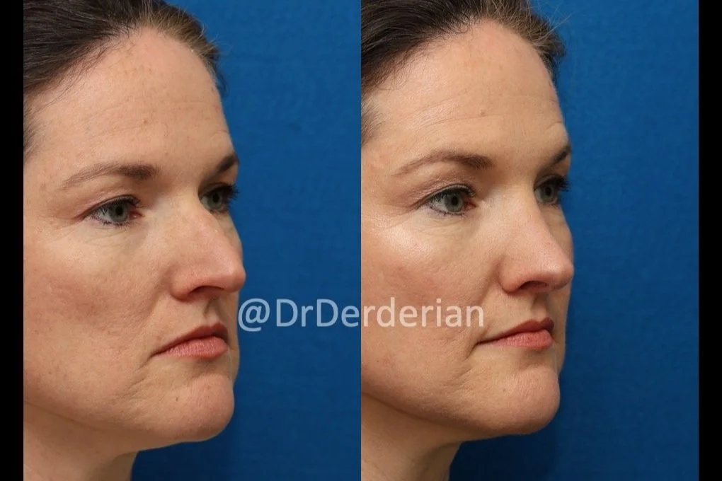 rhinoplasty before and after 2.12.25 right 3:4.jpg