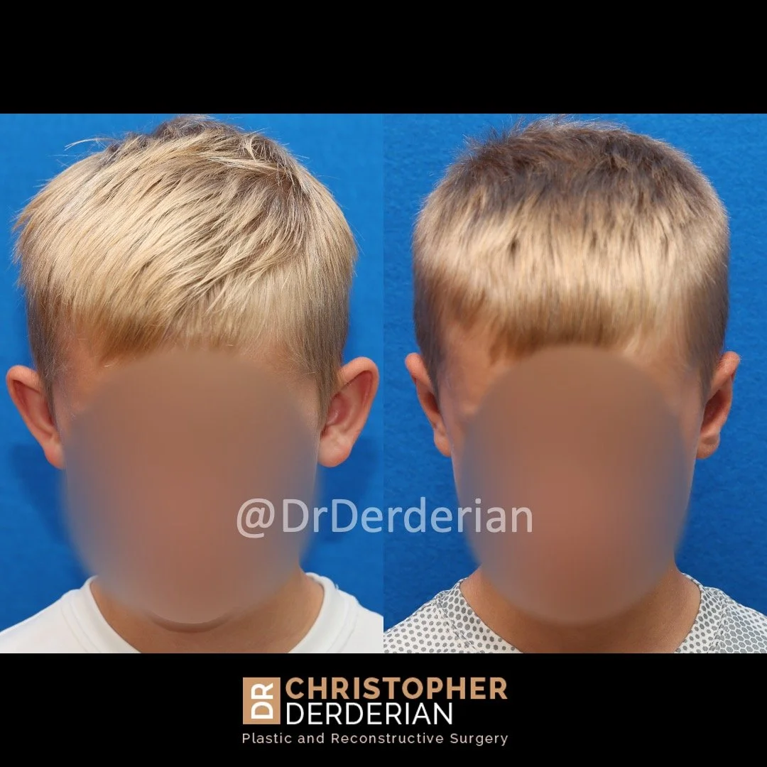 before and after photo otoplasty above view