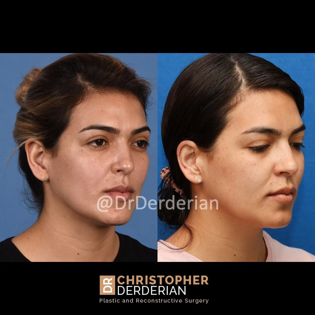 before and after ear reduction procedure, reduction otoplasty right 3/4