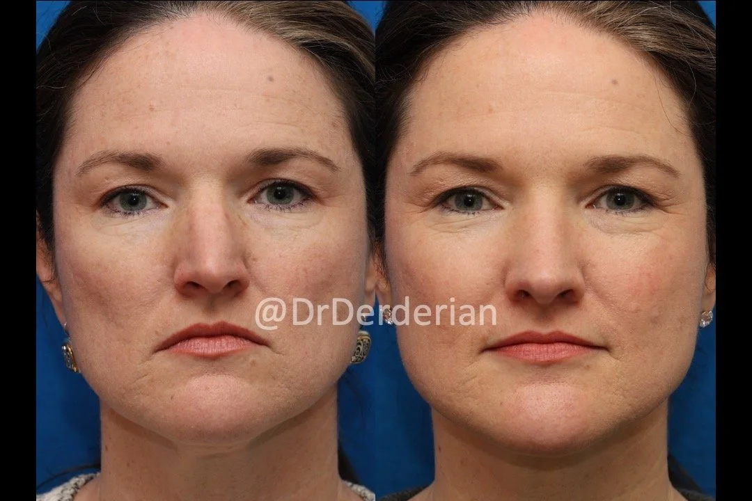 drderderian rhinoplasty before and after 2.12.25 AP.jpeg