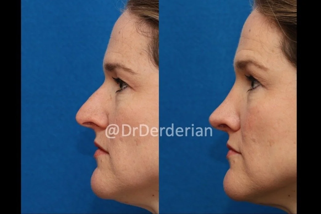 rhinoplasty before and after 2.12.25 left lateral.jpg