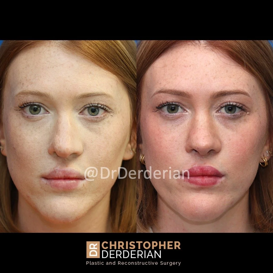 Before and after cleft rhinoplasty front view