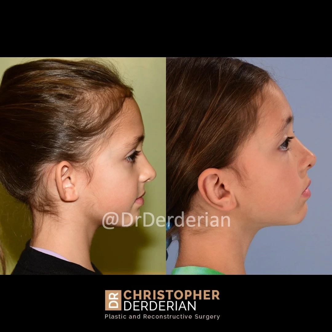 before and after otoplasty case 10 right lateral