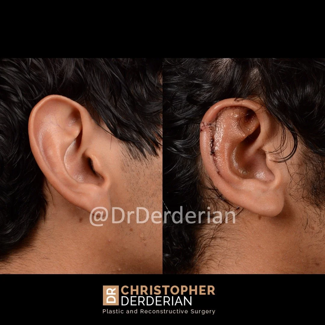 Alhudapk Com Macrotia Ear Reduction Surgery Cost Large Ear