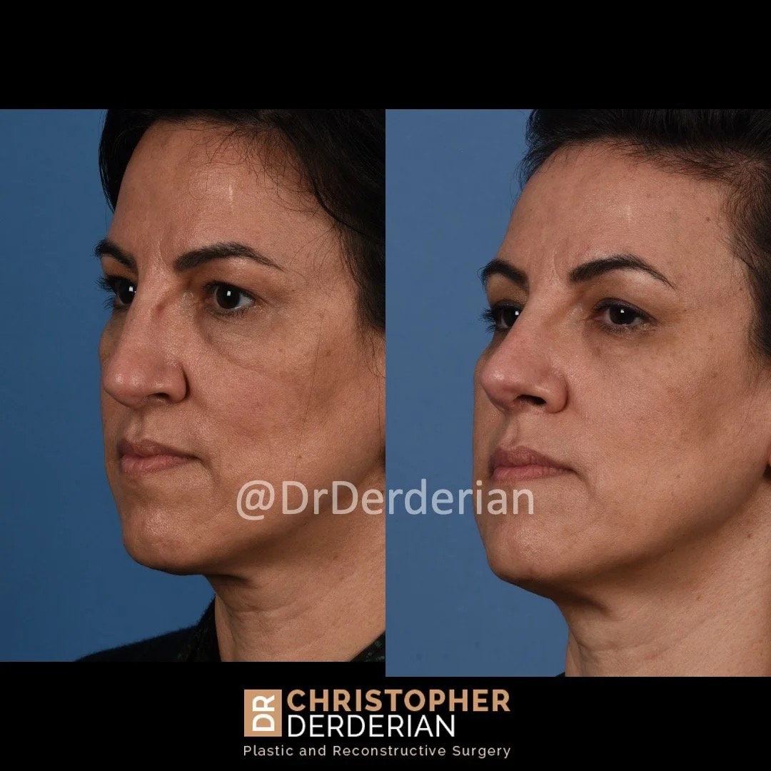 drderderian Instagram Before and After Rhinoplasty 5.5.22 6 month follow up left 3:4.jpeg
