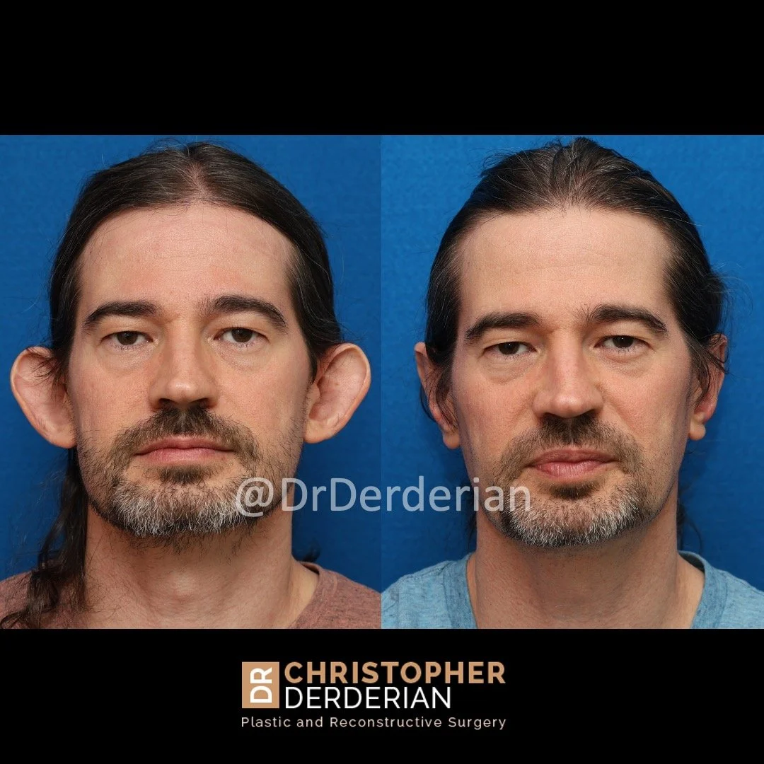 Otoplasty Before and After Photos front view