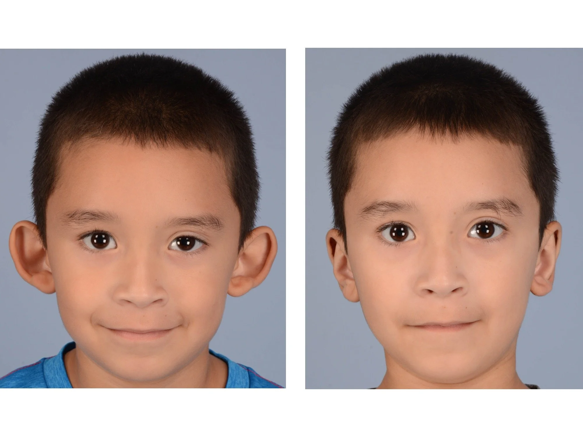 before and after otoplasty case 4 AP
