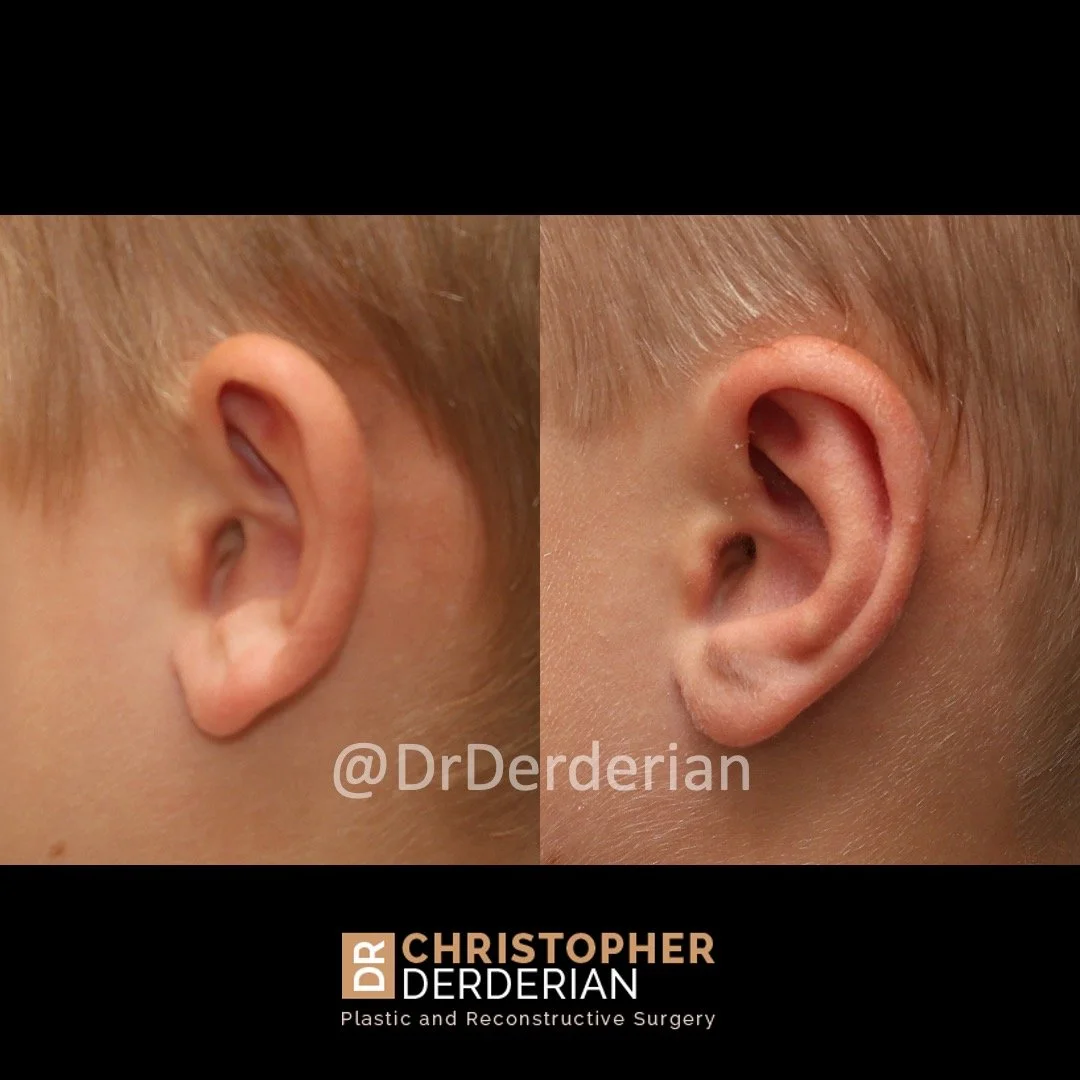 before and after photo otoplasty left view