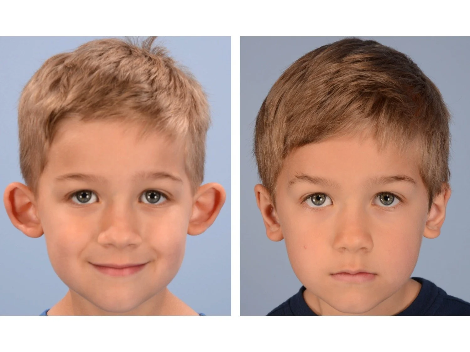otoplasty before and after case 1 AP