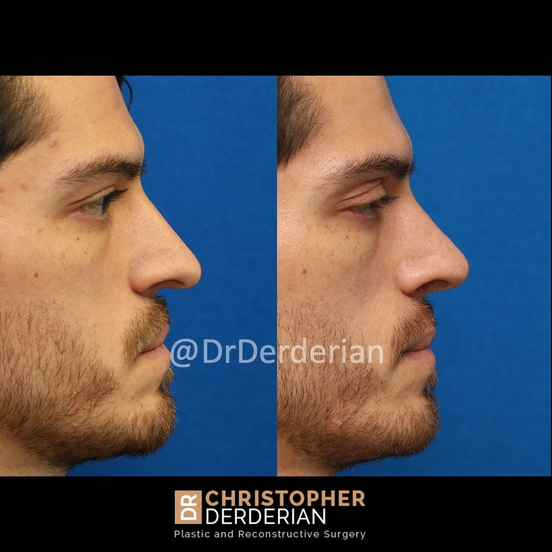 before and after cleft rhinoplasty right lateral