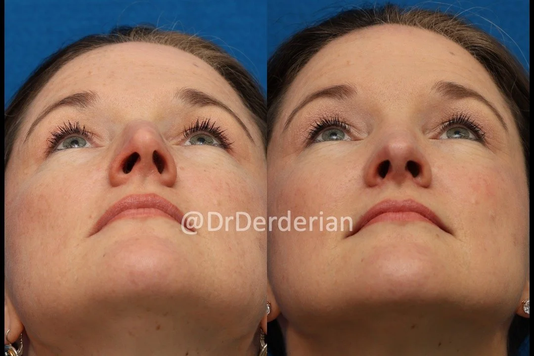 rhinoplasty before and after 2.12.25 Below.jpeg