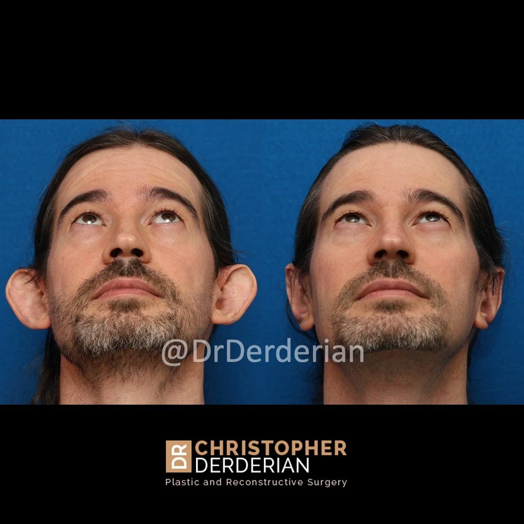 Otoplasty before and after photos below view