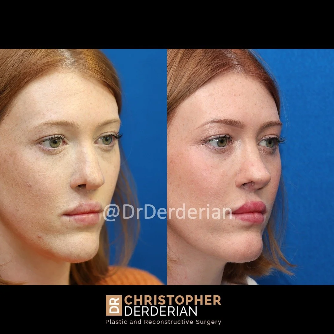 Before and after cleft rhinoplasty right 3/4