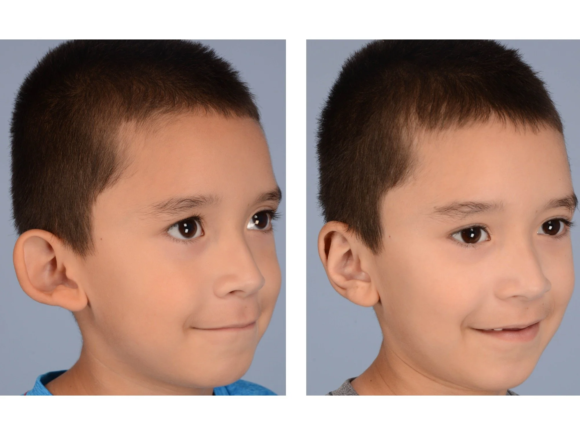 before and after otoplasty case 4 right 3/4