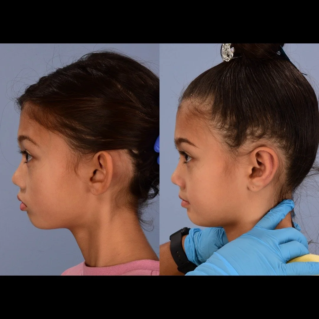 otoplasty before and after case 3 left lateral