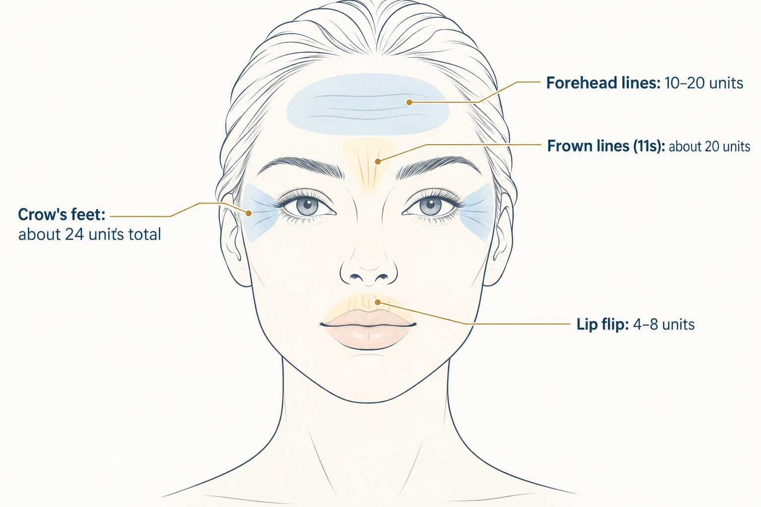 Face diagram showing typical Botox units for forehead, frown lines, crow's feet, and lip flip