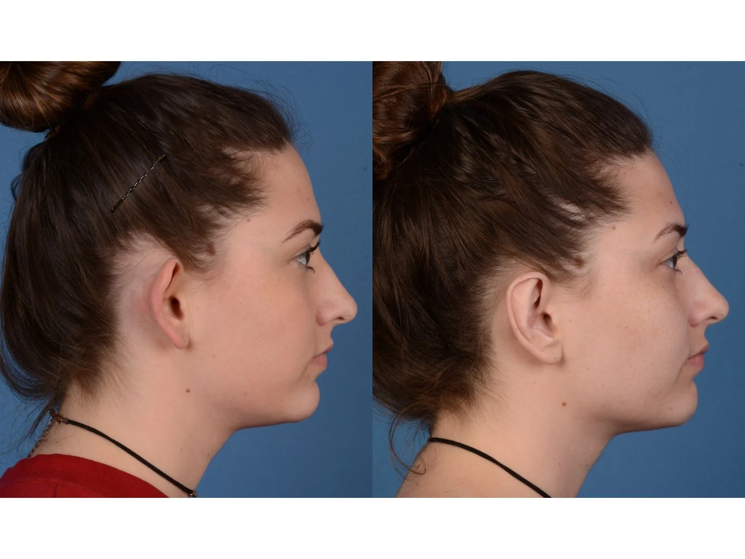 before and after otoplasty case 6 right lateral