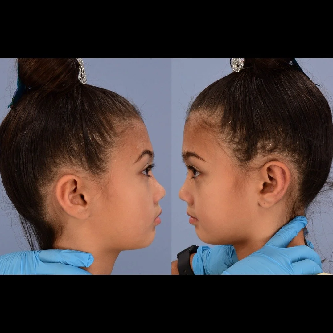 otoplasty before and after case 3 lateral mirror images