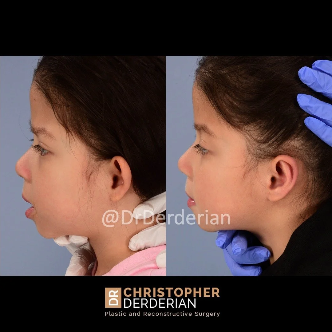 before and after otoplasty case 8 left lateral