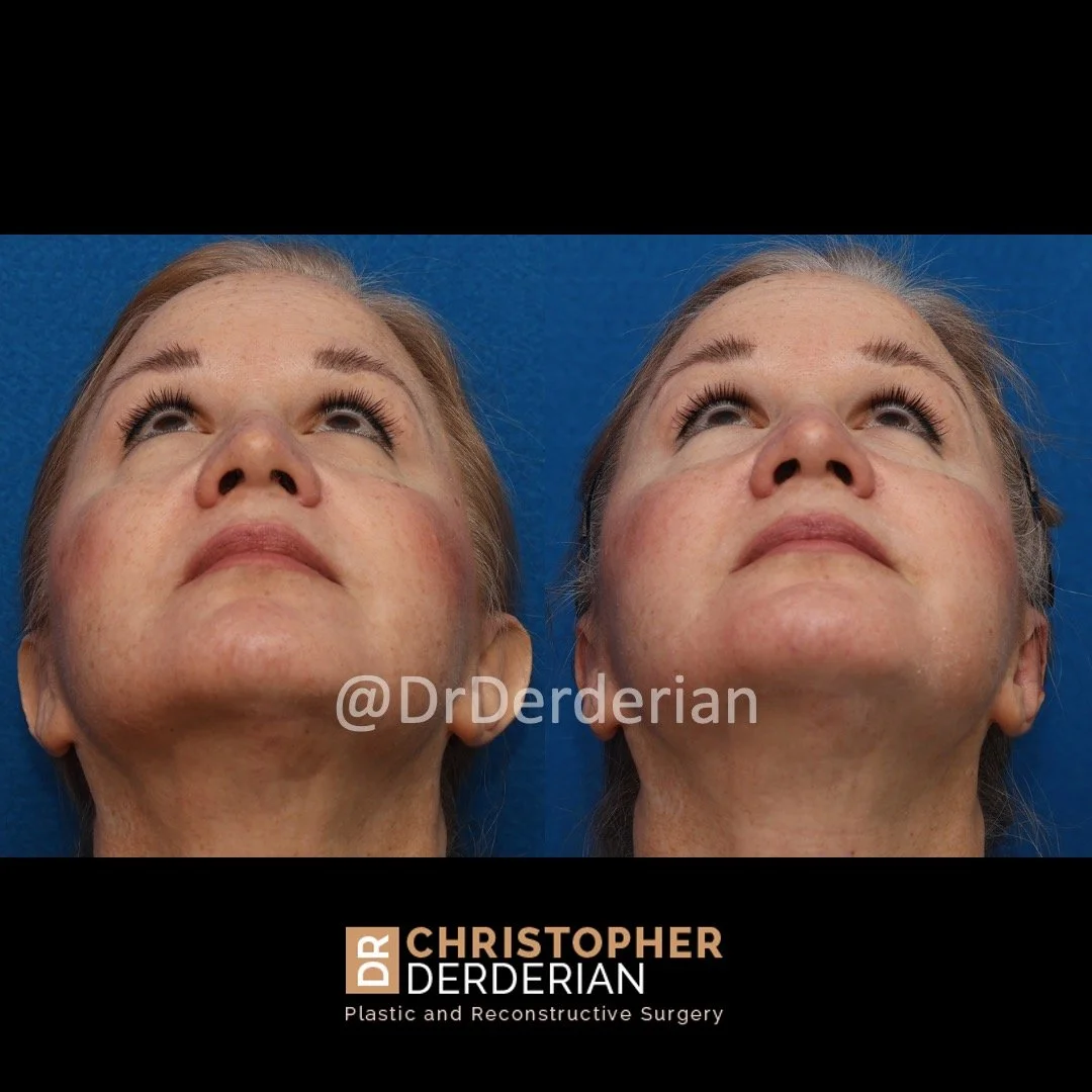 Before and after ear reduction surgery