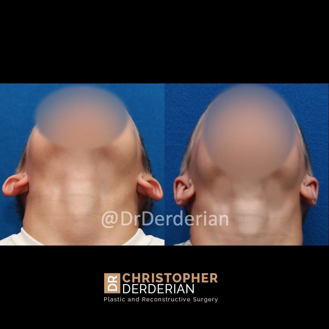 before and after photo otoplasty below view
