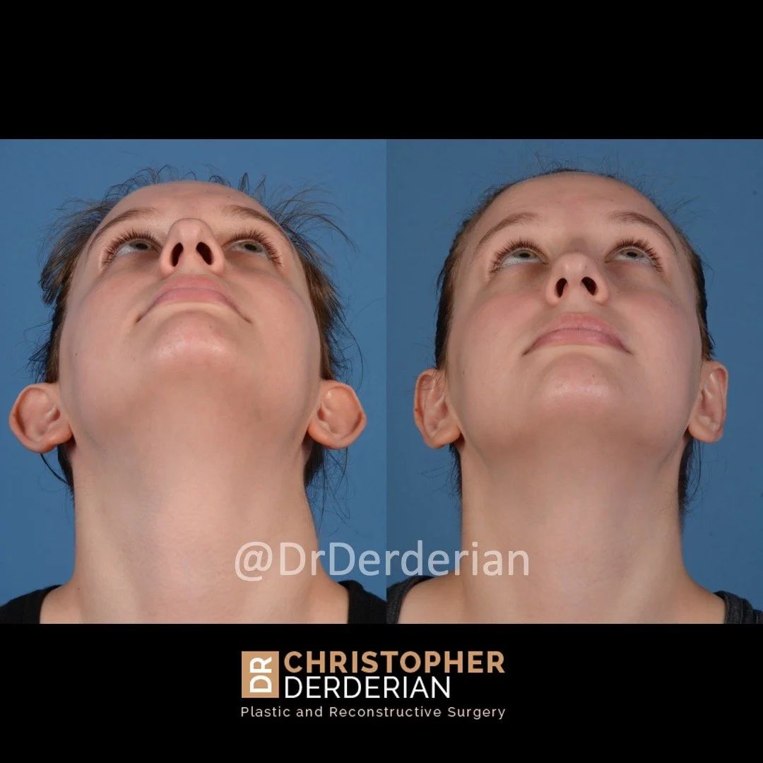 otoplasty before and after case 2 below view