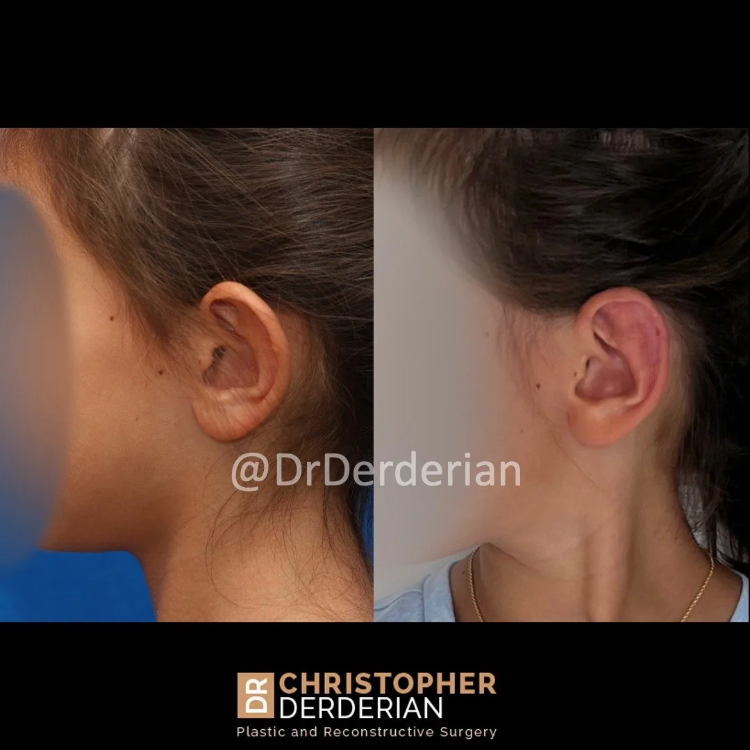 Before and after ear reduction + otoplasty left lateral view