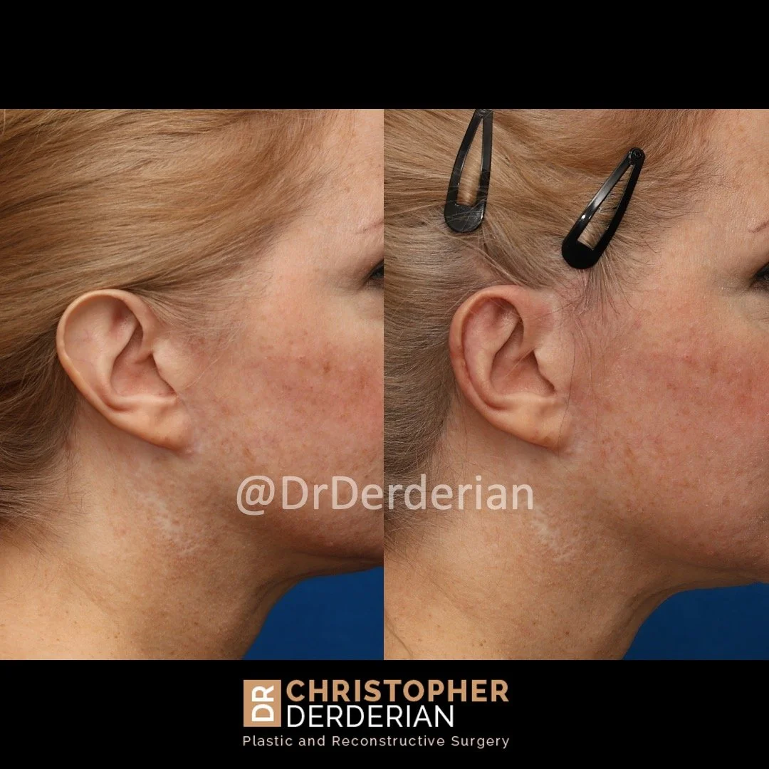 Before and after ear reduction surgery right lateral