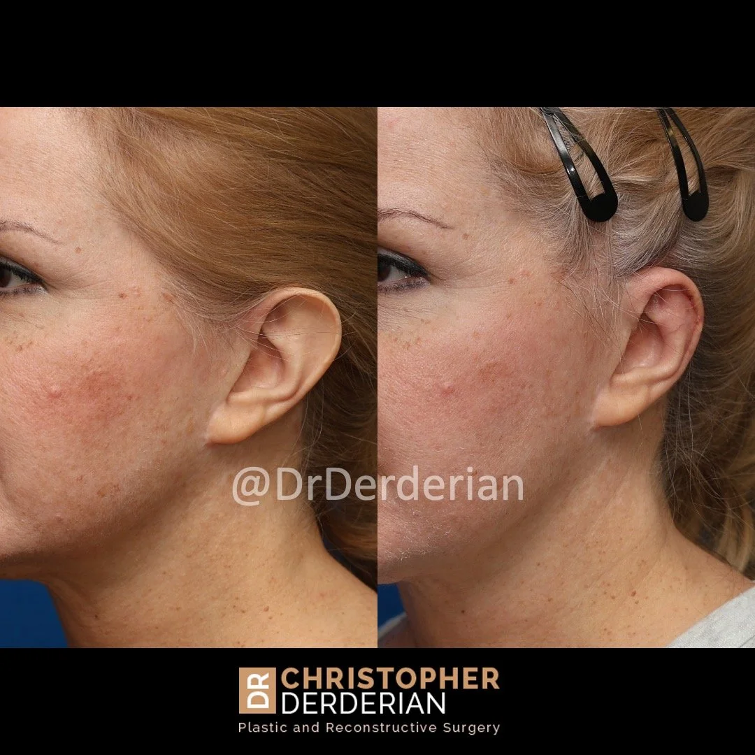 Before and after ear reduction surgery left 3/4