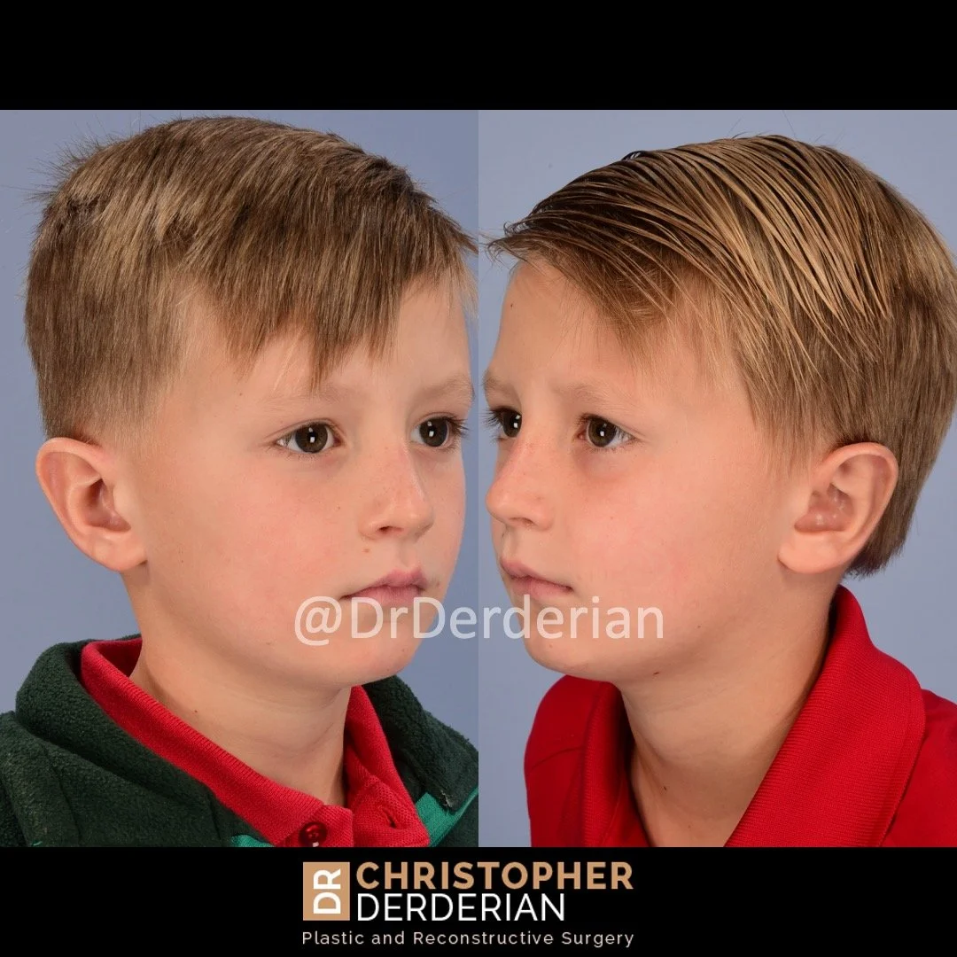 before and after otoplasty case 7 mirror 3/4