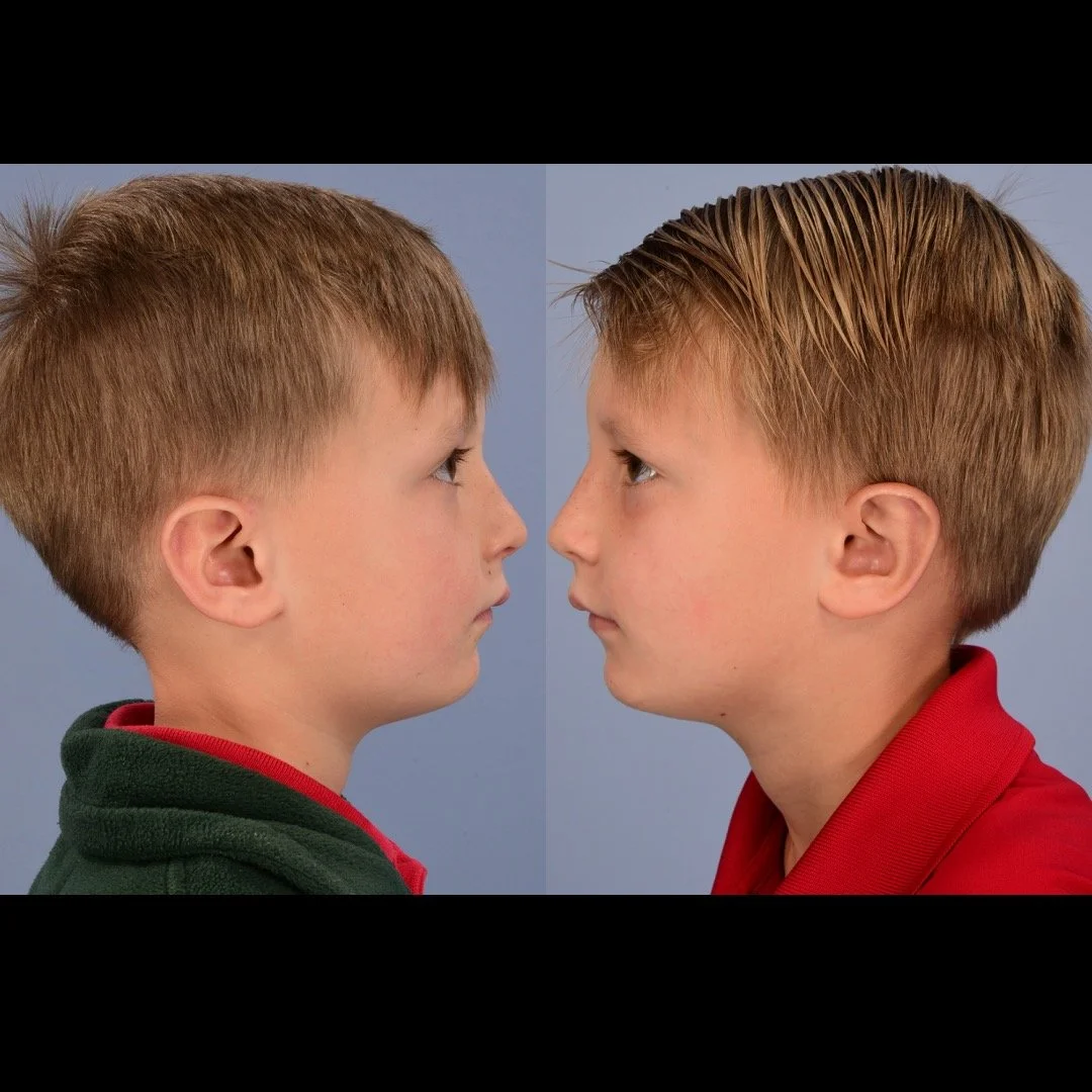 before and after otoplasty case 7 lateral mirror