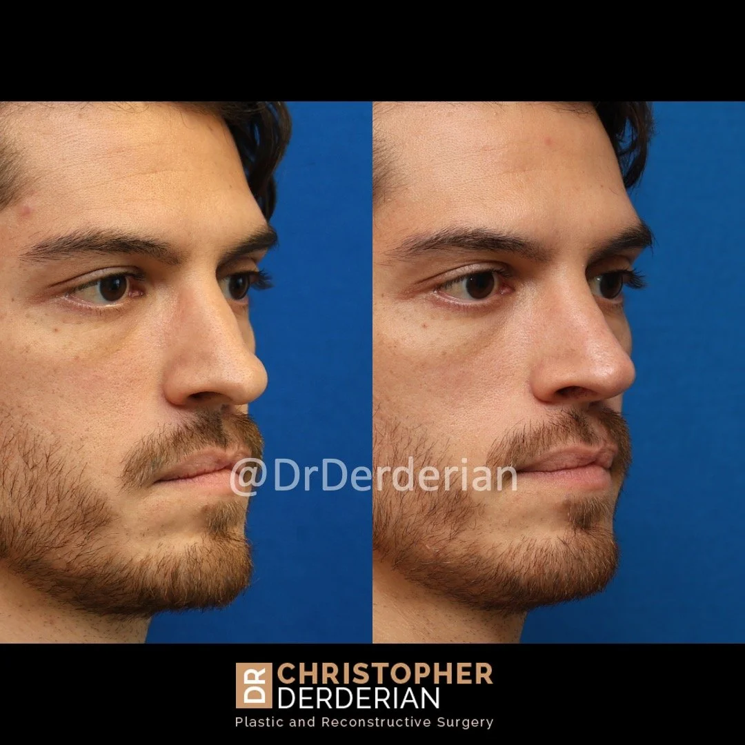 Before and after cleft rhinoplasty right 3/4