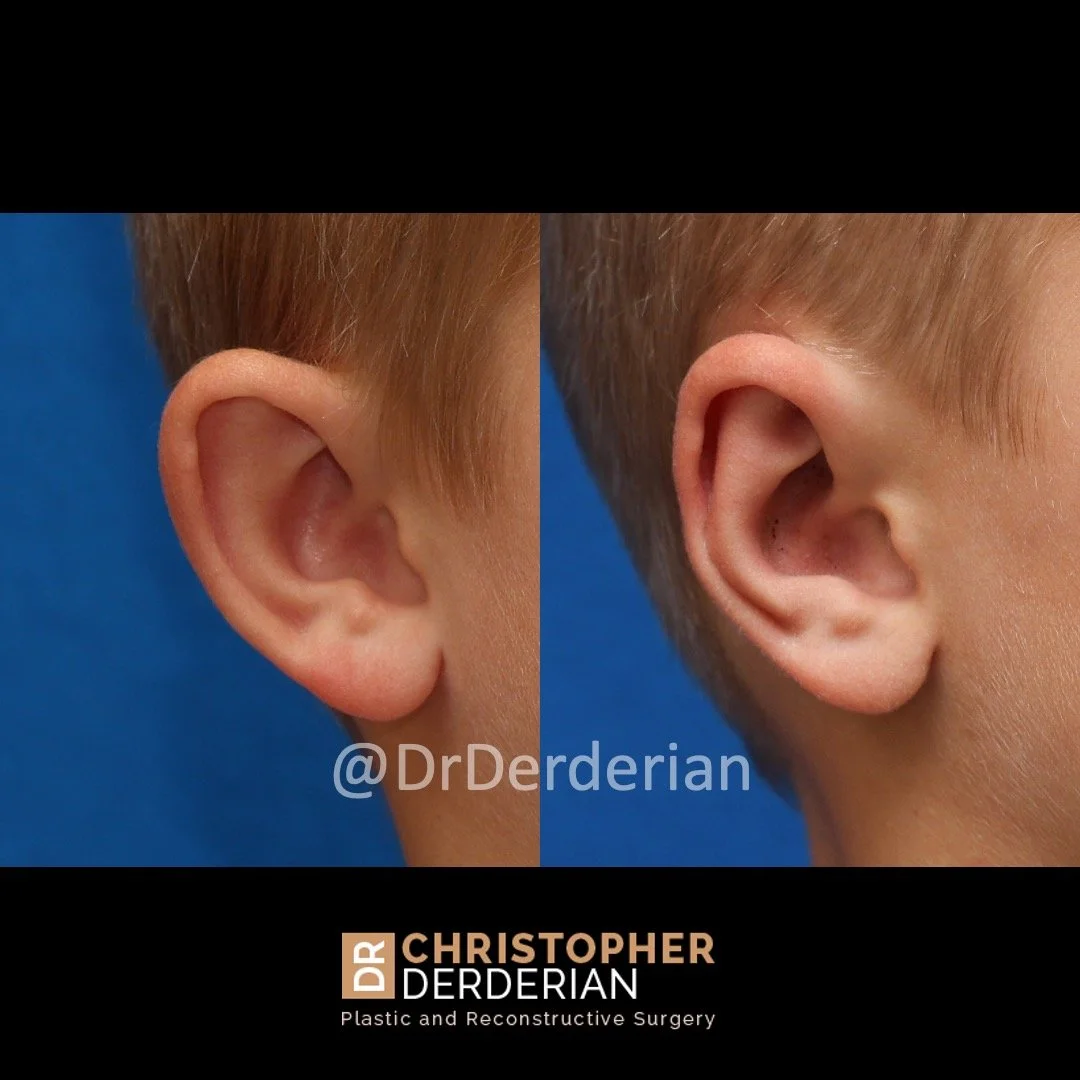 before and after photo otoplasty right 3/4 view