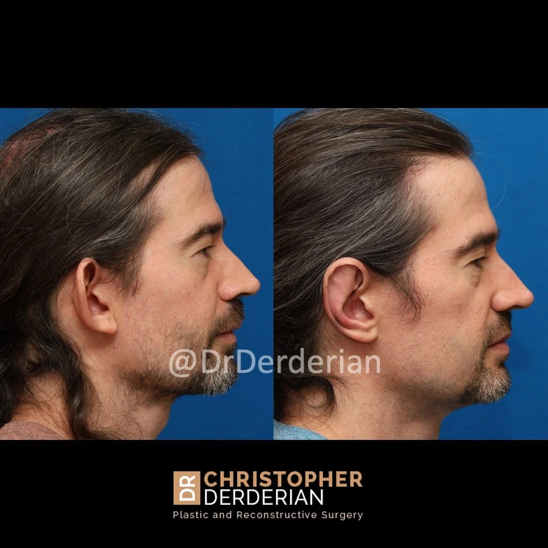 Otoplasty before an after right side view