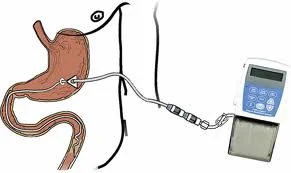 Everything I need to know about Duodopa and continuous dopamine pumps for Parkinson's disease