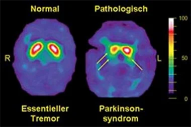 Do I really Need a DAT Scan to diagnose my Parkinson's Disease?