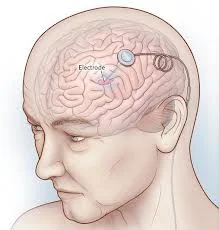 How Deep Brain Stimulation Changed the Lives of Parkinson's Patients