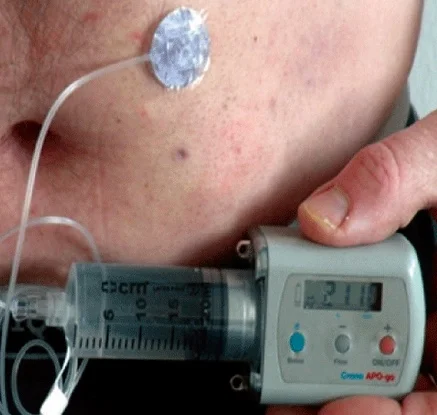 How about an apomorphine pump instead of DBS for Parkinson's Disease?