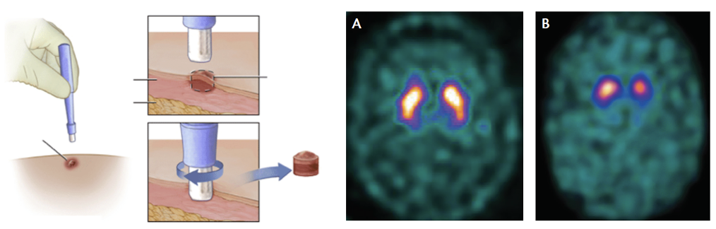 Do I need a skin biopsy or DaTscan for my Parkinson's disease?