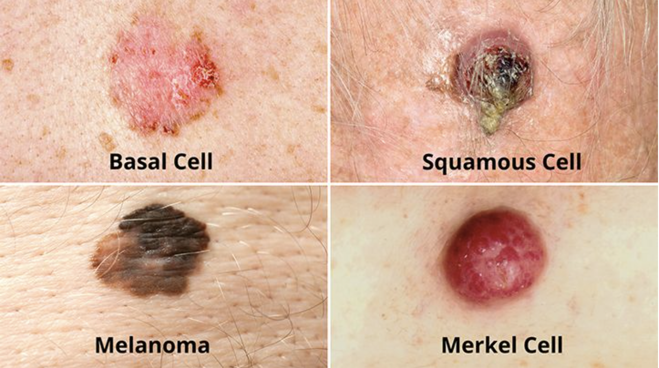 Melanoma risk is twice as high in Parkinson's: A call to counsel every person at every visit