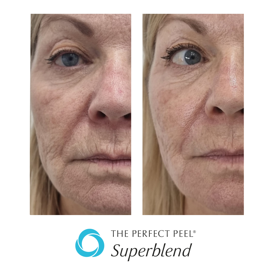TPP Superblend 3 treatments.png
